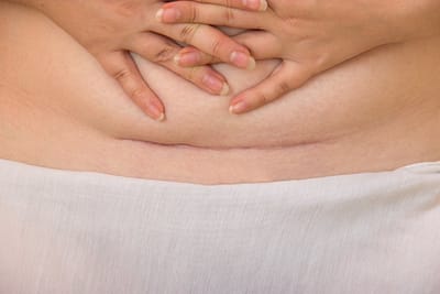Kaiserschnitt Beschwerden - damit müssen Sie nicht leben