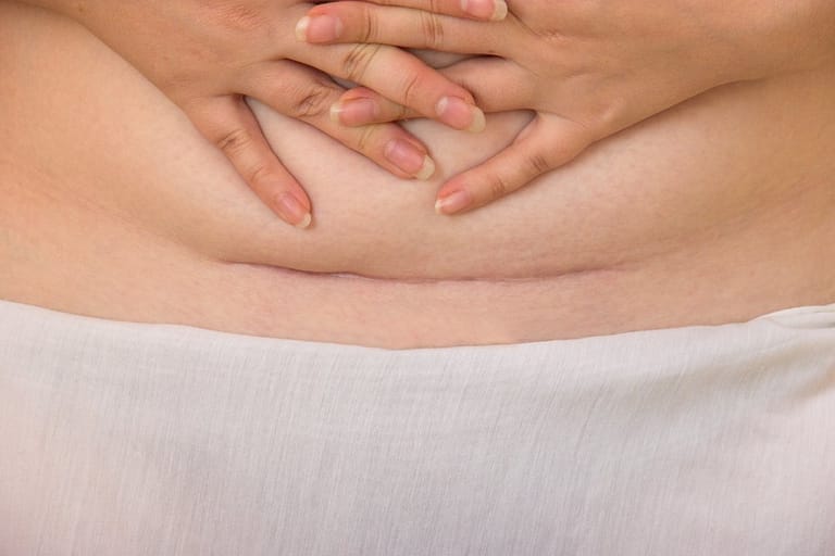 Kaiserschnitt Beschwerden – damit müssen Sie nicht leben